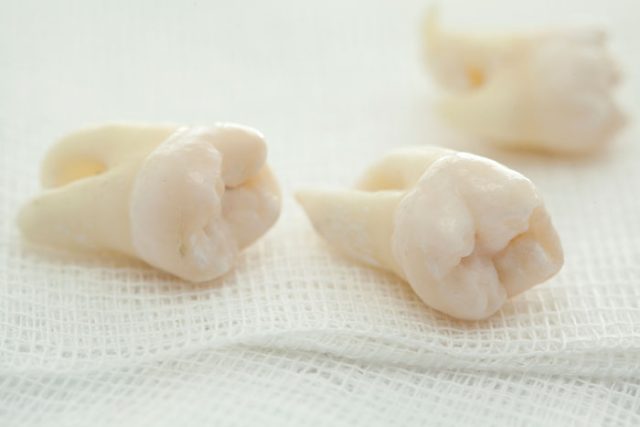 wisdom teeth removal in Boise