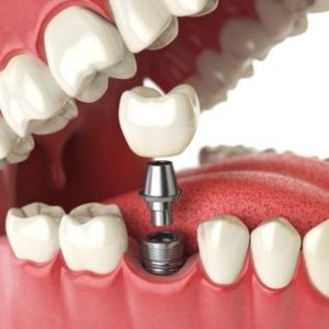 Dental implant illustration showing titanium post and crown placement in a jaw model, representing restorative dentistry and dental implant process at Times Square Dental in Boise, Idaho.