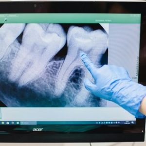 Dental X-ray image on a computer screen with a gloved hand pointing, illustrating oral surgery diagnostics at Times Square Dental in Boise, ID.