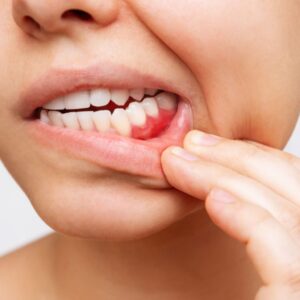 GUM DISEASE